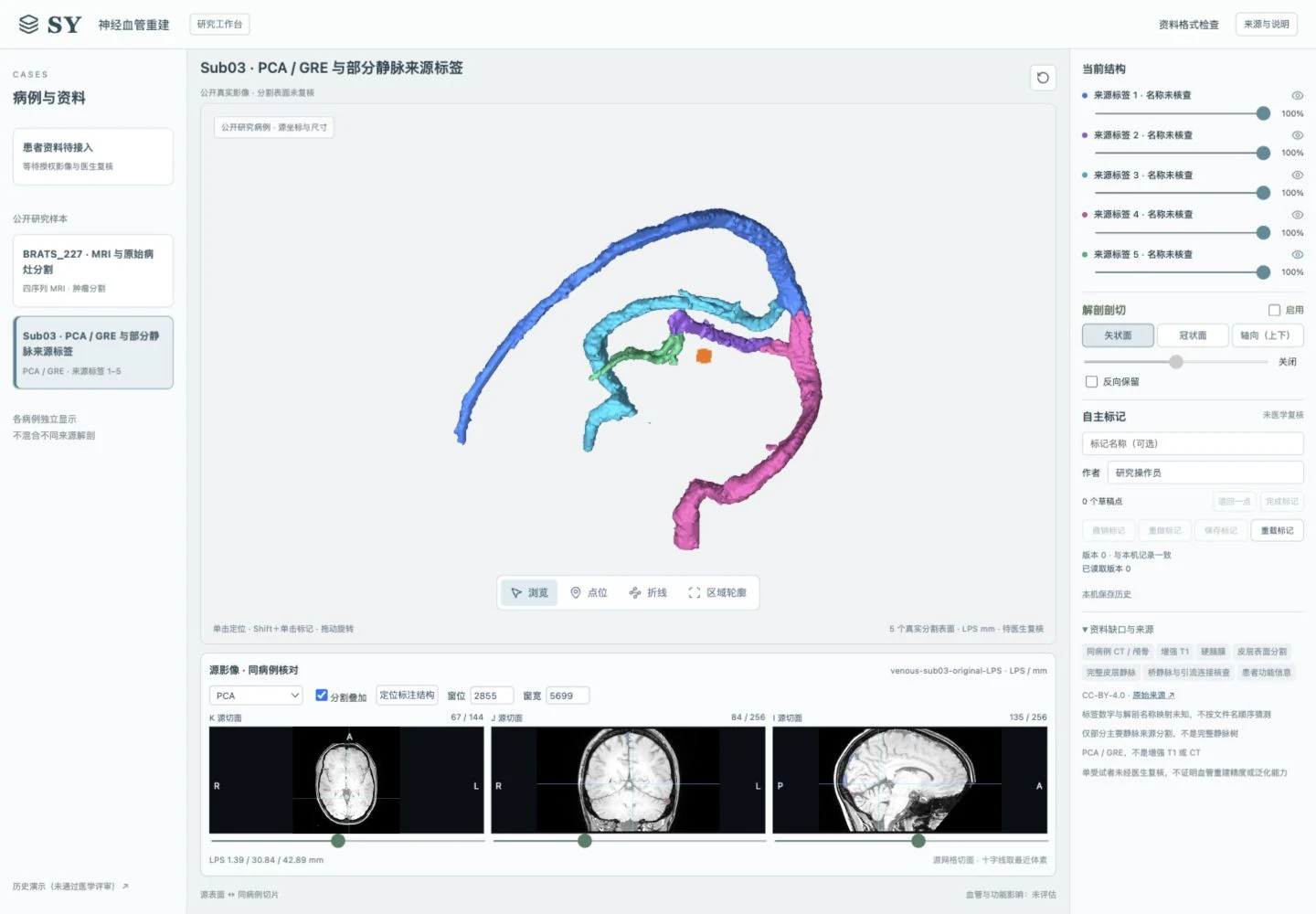Neurosurgical Vascular Reconstruction System with venous segmentation surfaces and three source MRI slices
